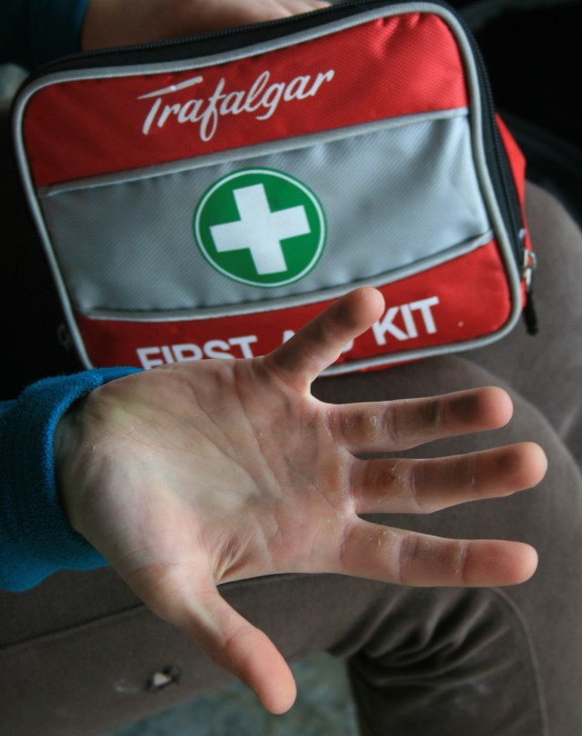 Climbers hands: The rock takes it's toll on athletes.